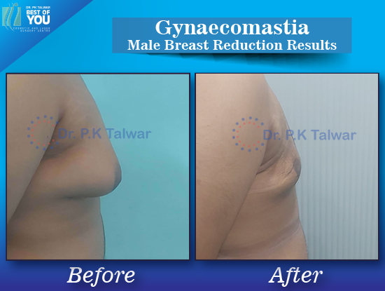 Gynaecomastia before after image